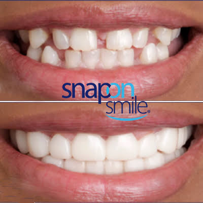 Snap On Smile (PL) 5