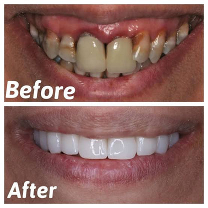 Snap On Smile (PL) 7