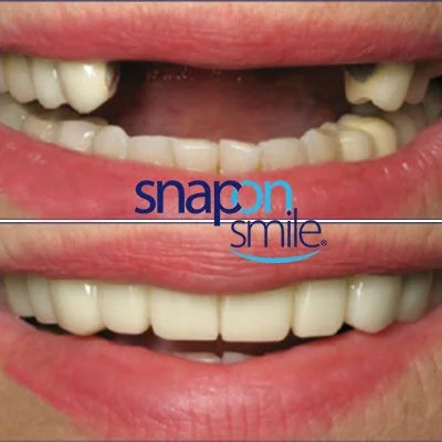 Snap On Smile (PL) 1